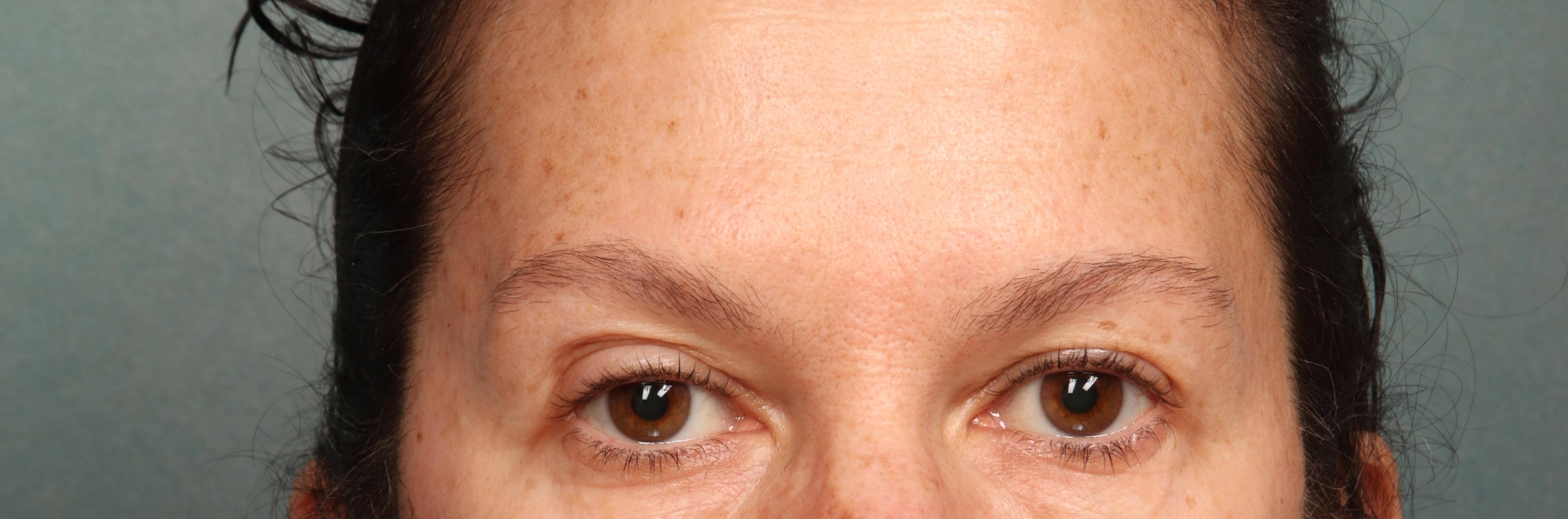 Botox Case 6 After