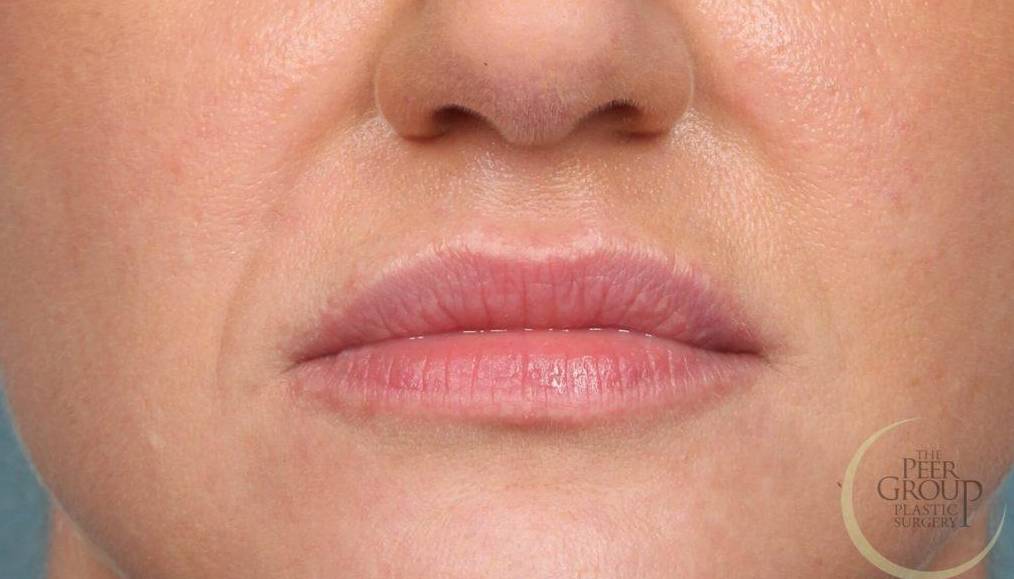 Lip Augmentation Case 1 After