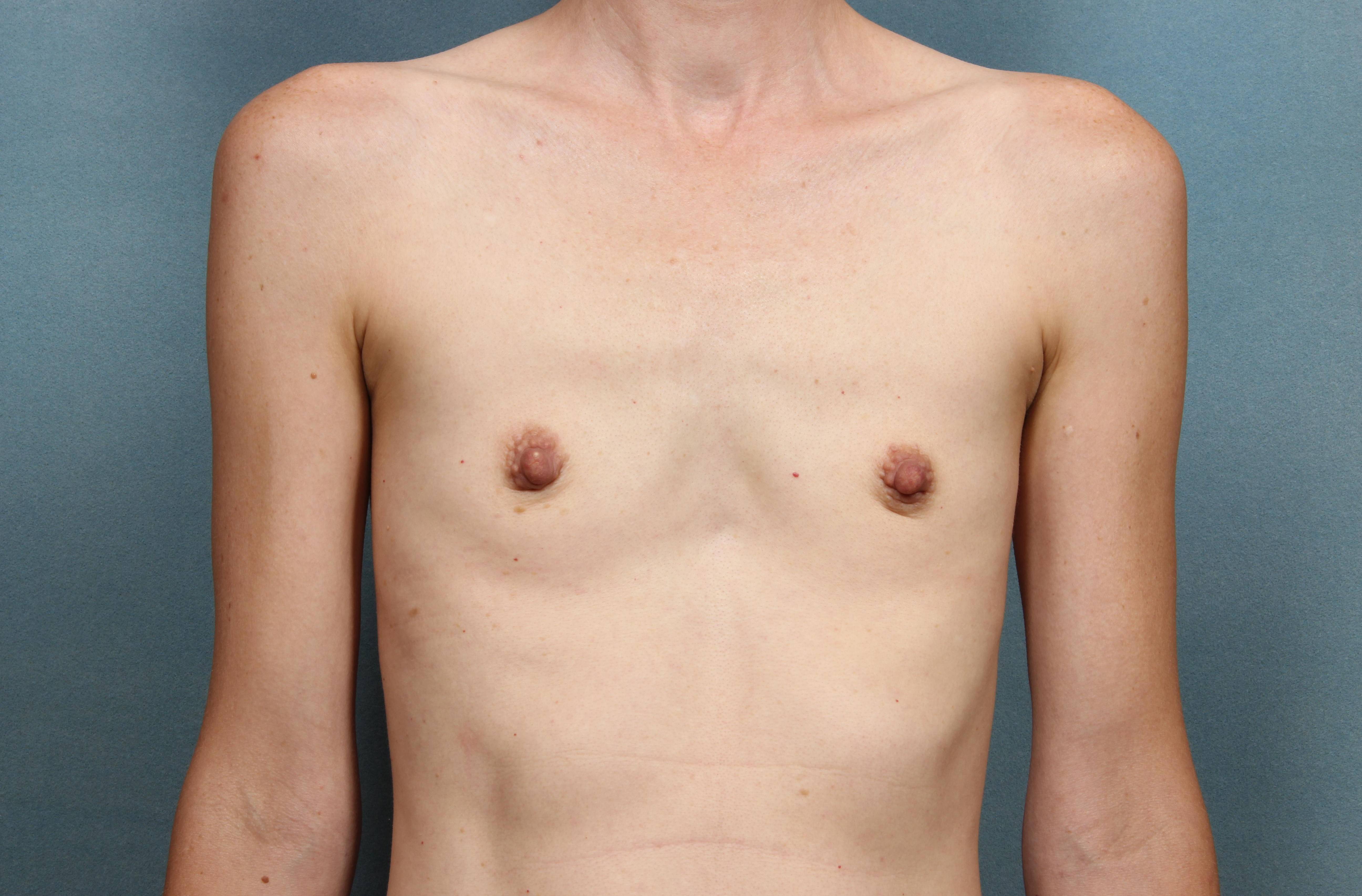 Breast Augmentation Case 28 Before