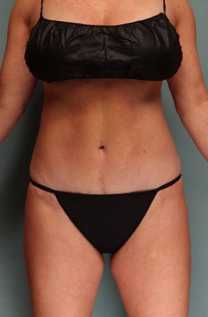 Tummy Tuck Case 22 After
