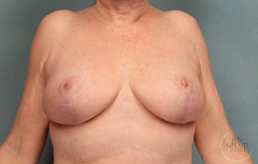 Breast Lift Case 3 After
