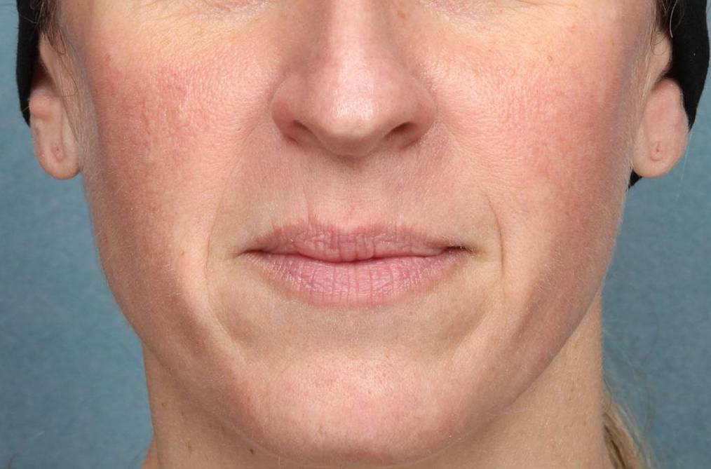 Juvederm Vollure Case 1 Before