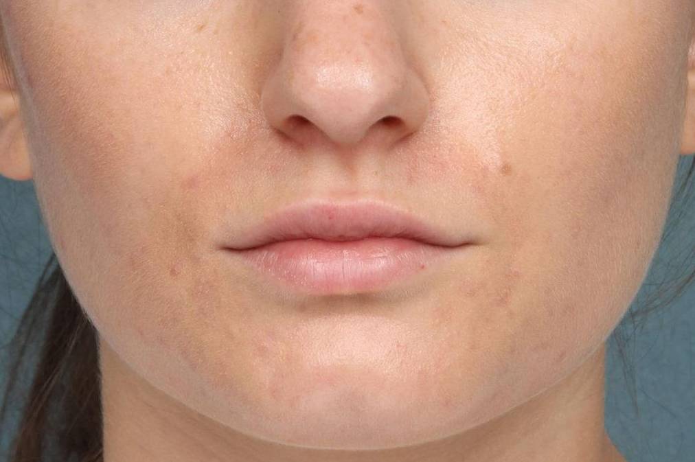Juvederm Vollure Case 3 Before