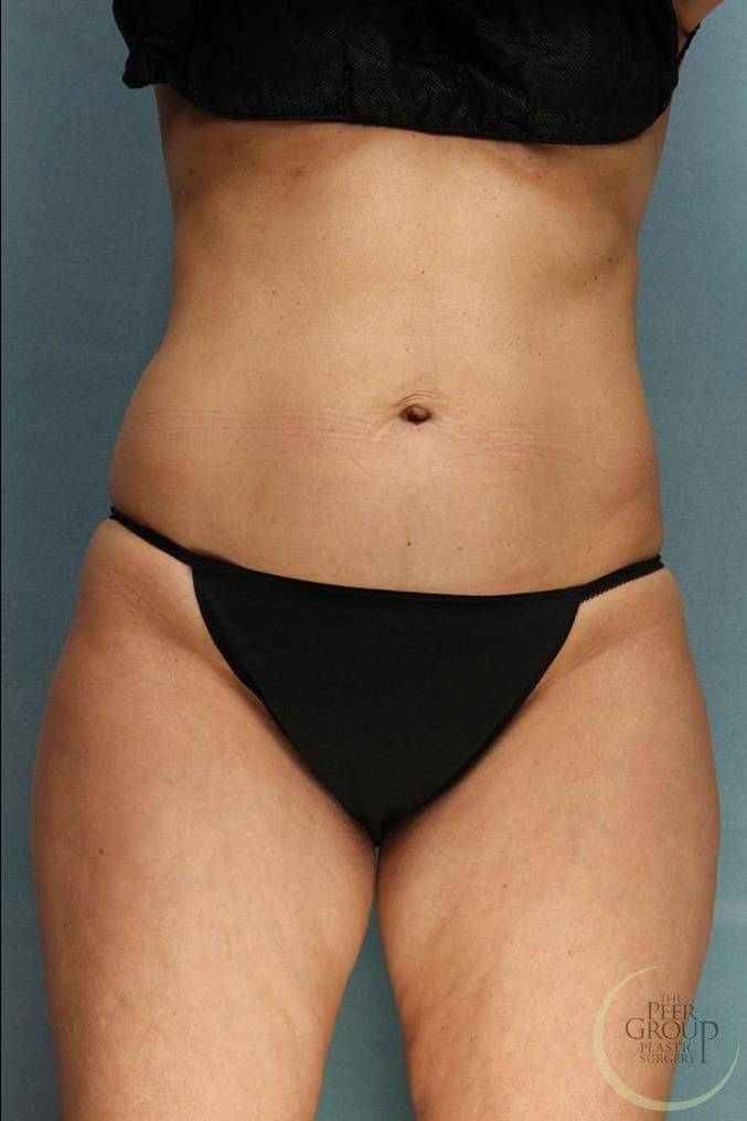 Coolsculpting Case 4 Before