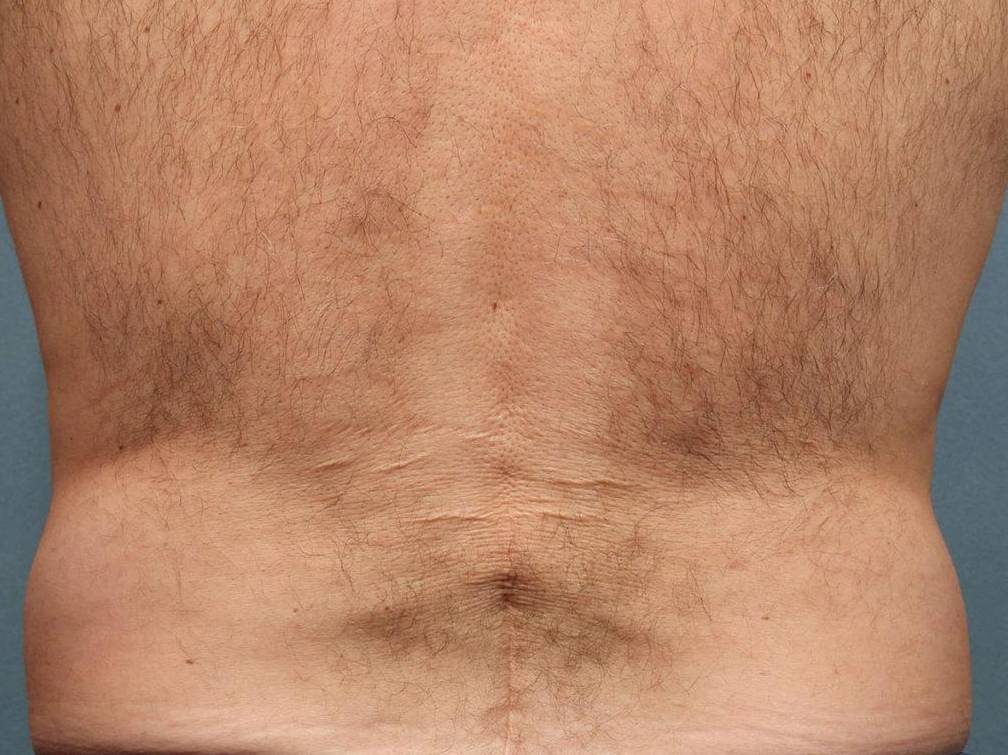 Coolsculpting Case 7 Before
