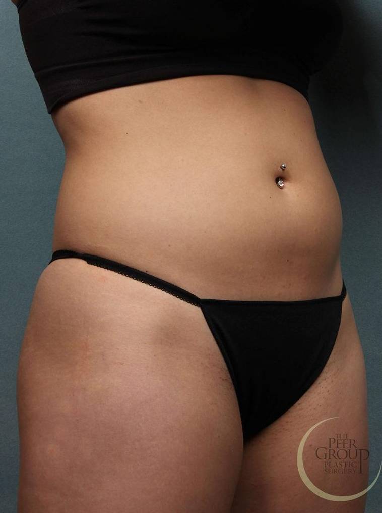 Coolsculpting Case 9 Before