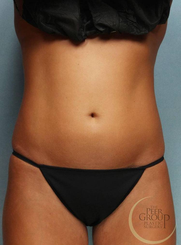 Coolsculpting Case 12 Before