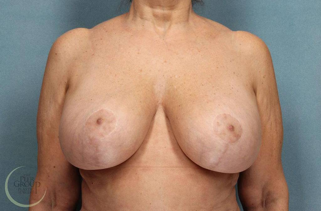 Breast Revisions Case 1 After