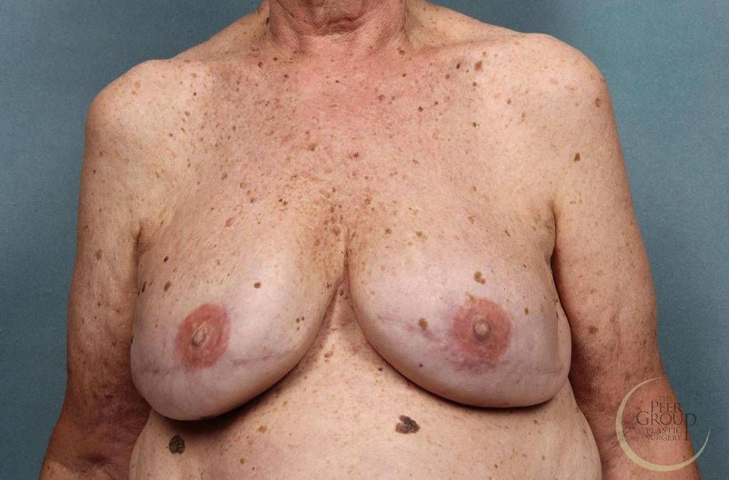 Breast Reconstruction Case 3 After