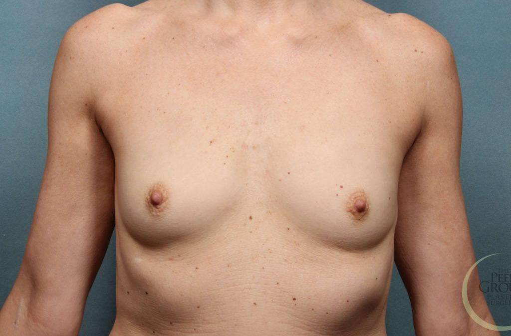 Breast Augmentation Case 8 Before