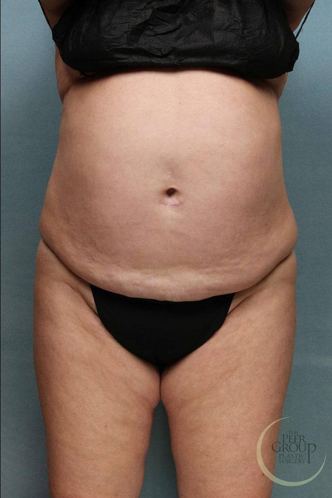 Liposuction Case 1 Before