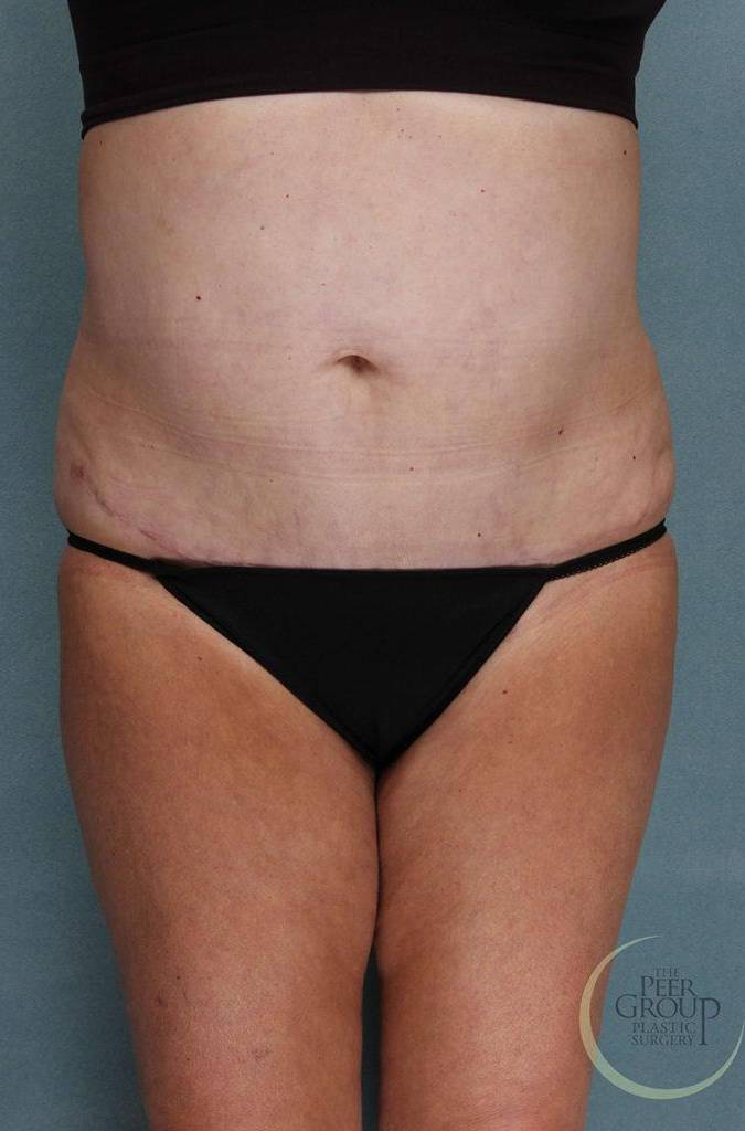 Liposuction Case 4 After