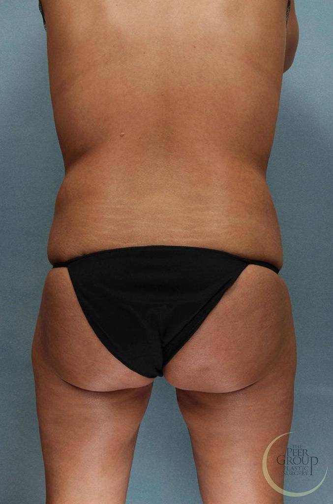 Liposuction Case 5 Before