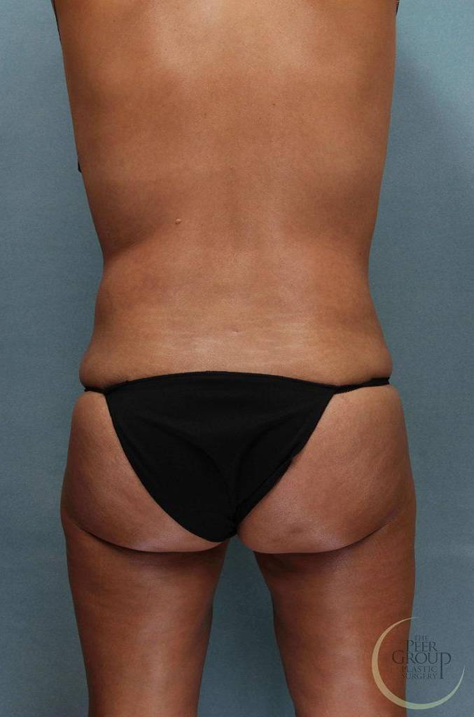 Liposuction Case 5 After