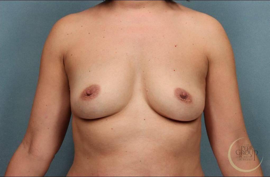 Breast Augmentation Case 2 Before