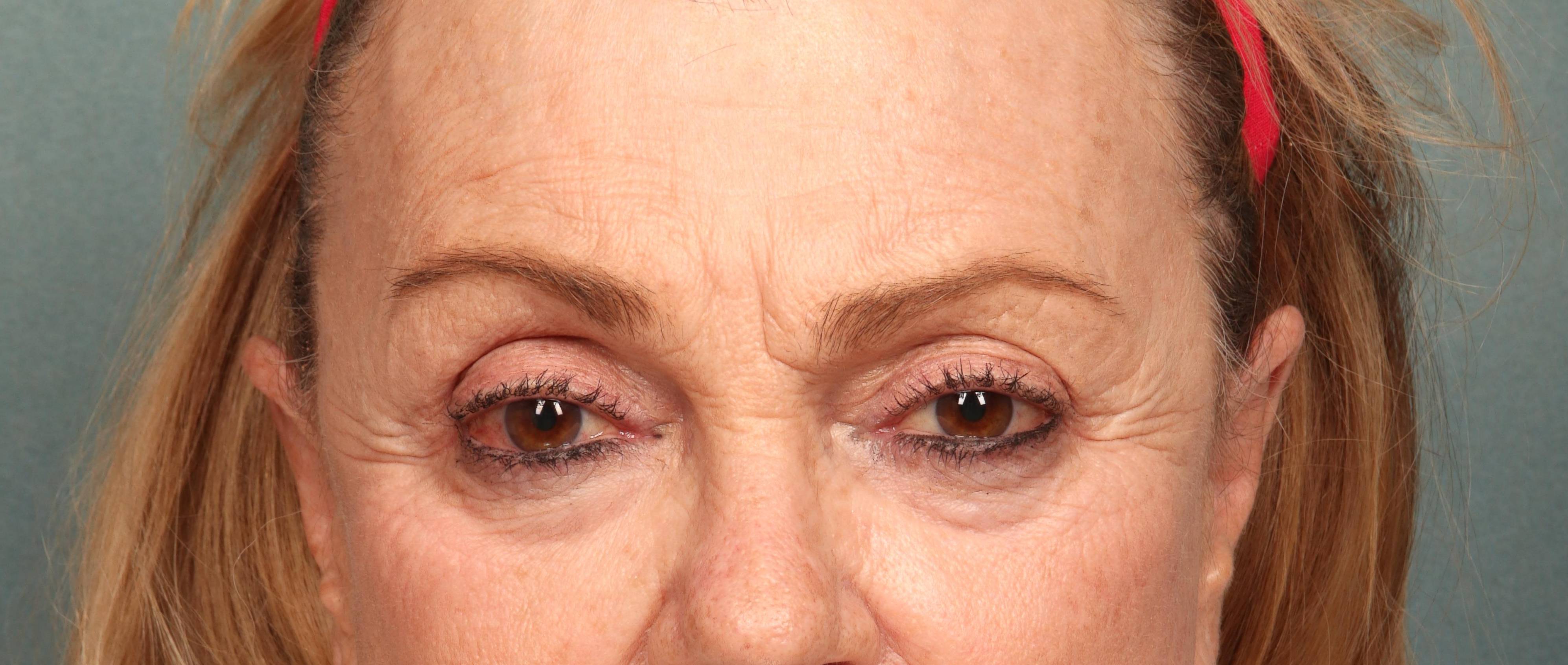 Brow Lift Case 7 Before