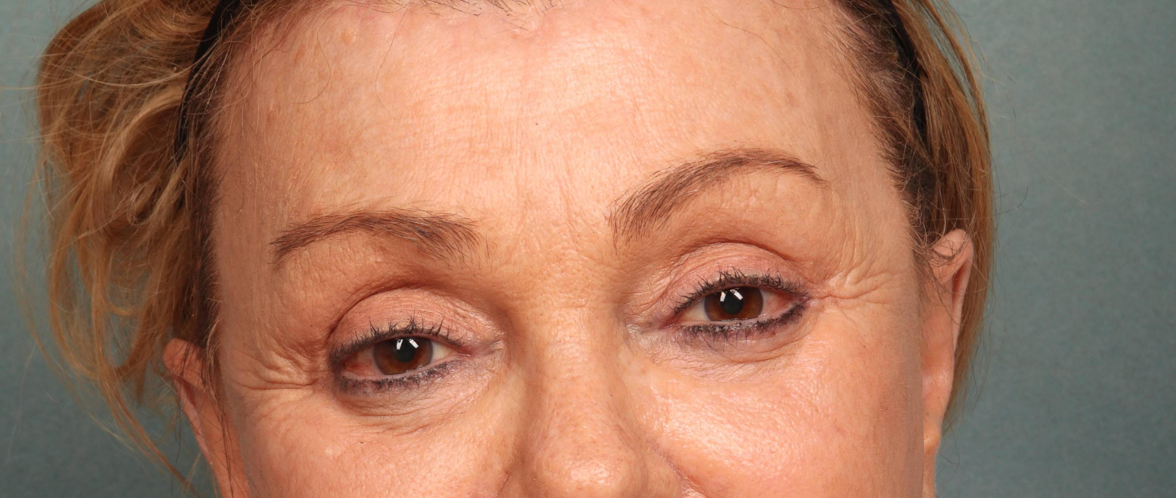 Brow Lift Case 7 After