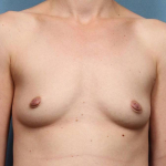 Breast Augmentation Case 17 Before