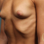 Breast Augmentation Case 18 Before