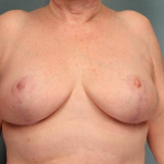 Breast Lift Case 21 After