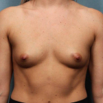 Breast Augmentation Case 4 Before