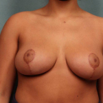Breast Reduction Case 27 After