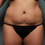 Coolsculpting Case 106 Before