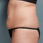 Coolsculpting Case 107 Before