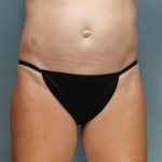 Coolsculpting Case 110 Before