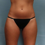 Coolsculpting Case 113 Before