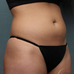 Coolsculpting Case 114 Before
