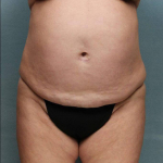 Liposuction Case 51 Before