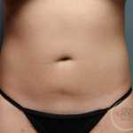 Liposuction Case 53 After