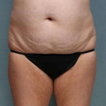 Liposuction Case 54 Before