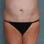 Liposuction Case 54 After