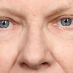 Brow Lift : 127 After