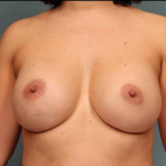 Breast Augmentation Case 2 After