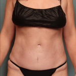 Tummy Tuck Case 165 After