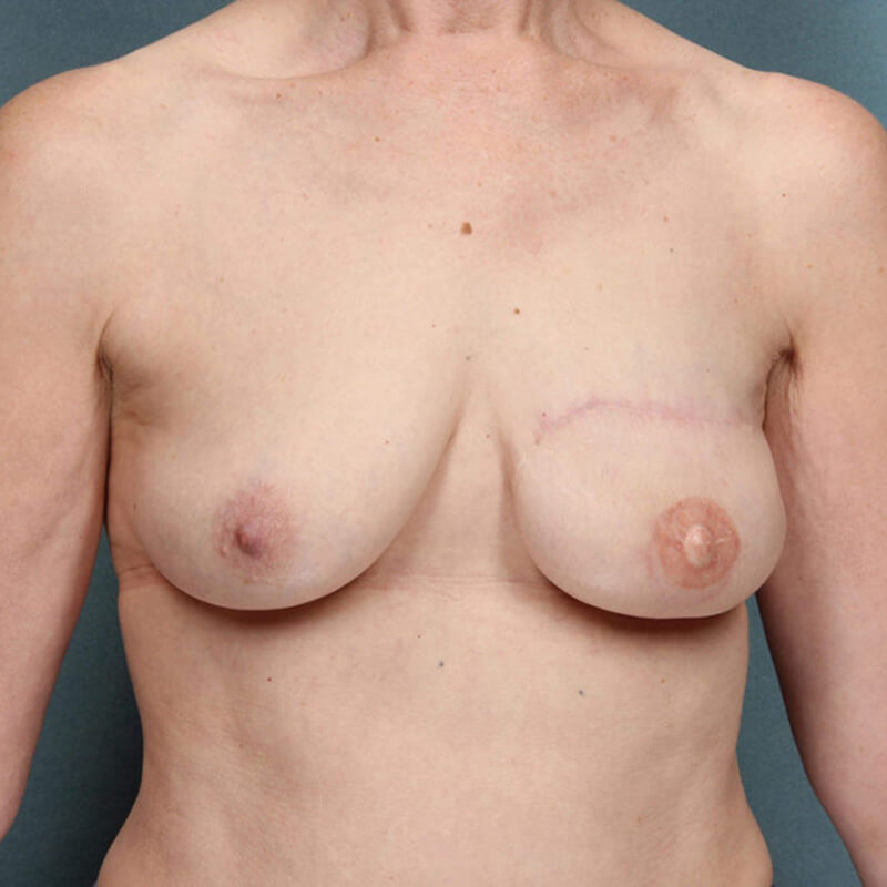 breast-reconstruction-case-1-front-after