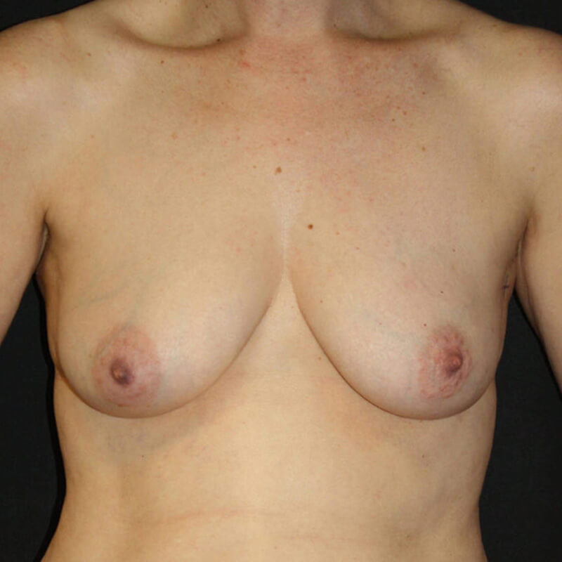 breast-reconstruction-case-1-front-before