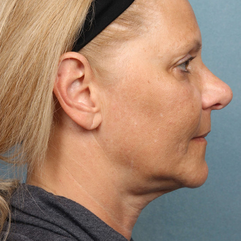 kybella-case-1-side-right-after