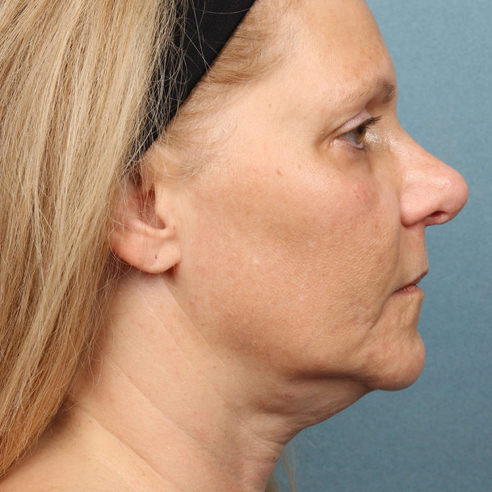 kybella-case-1-side-right-before