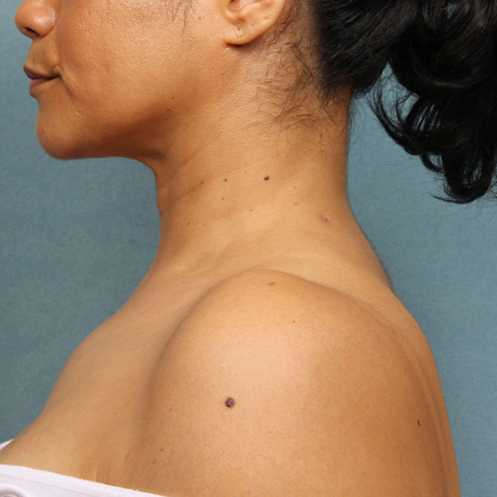 liposuction-case-1-side-left-after