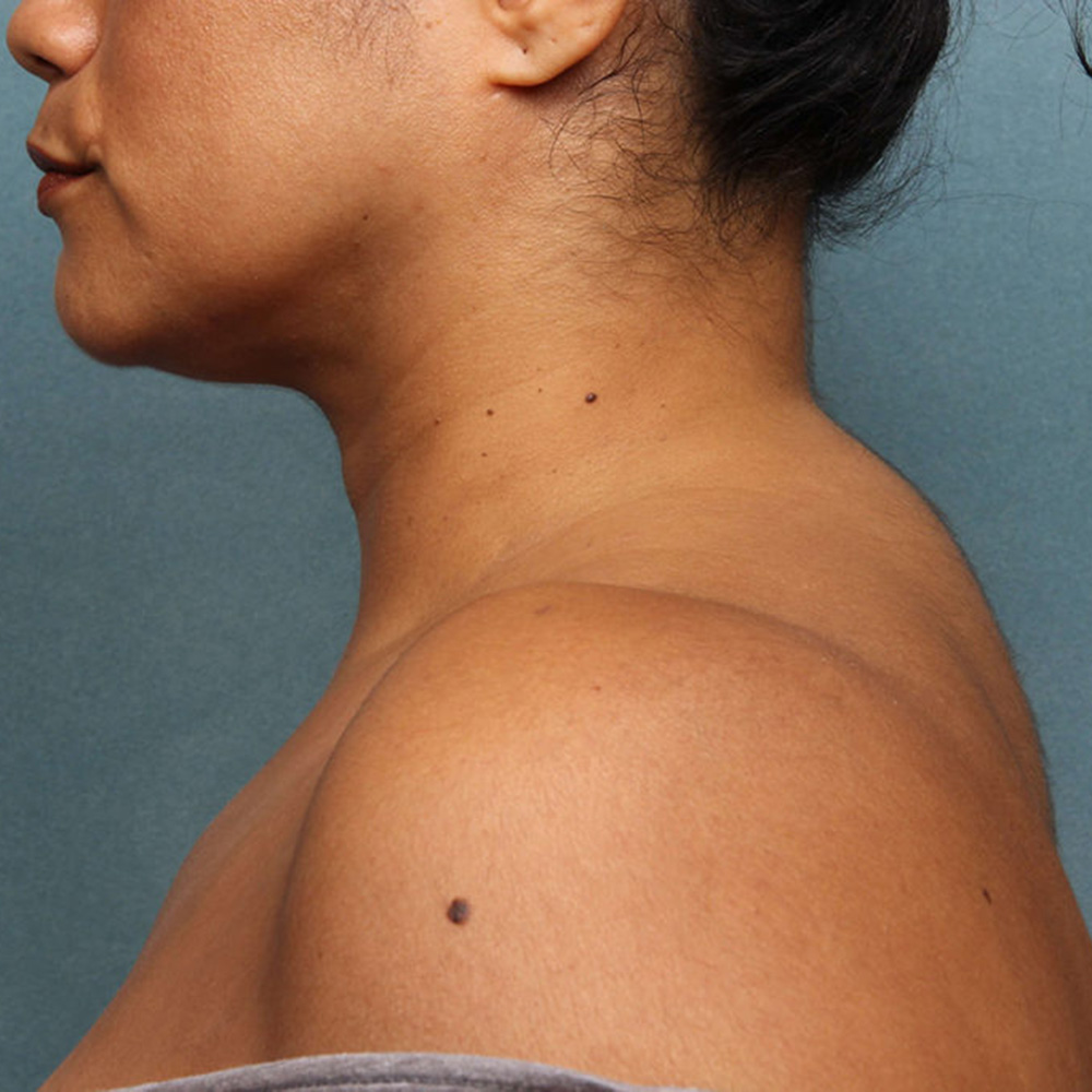 liposuction-case-1-side-left-before
