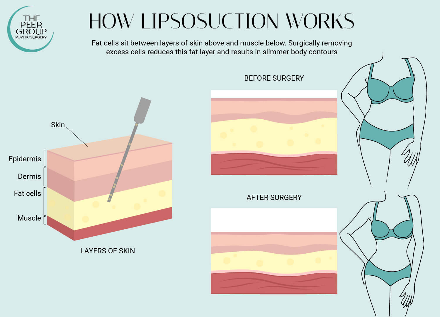 See how liposuction works at New Jersey’s The Peer Group.