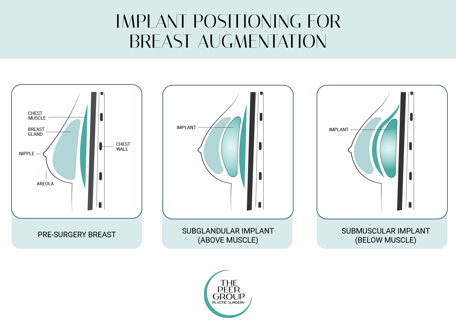 Compare subglandular and submuscular implant placement for breast augmentation at New Jersey’s The Peer Group.