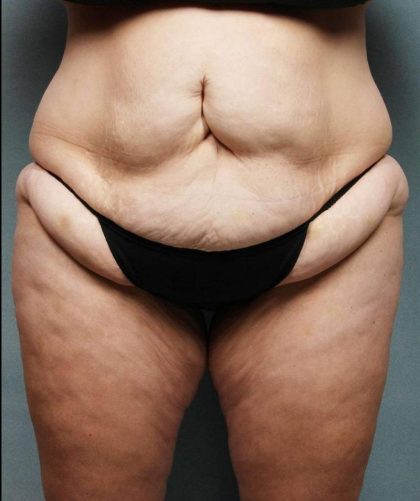 Weight Loss Before & After Patient #9172