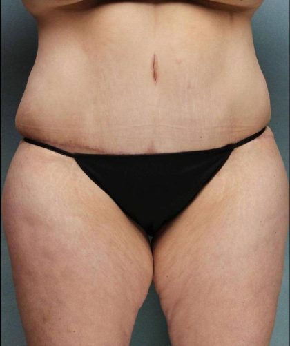 Weight Loss Before & After Patient #9172