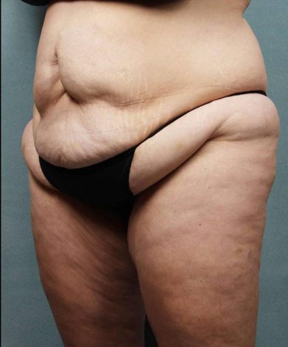 Weight Loss Before & After Patient #9172