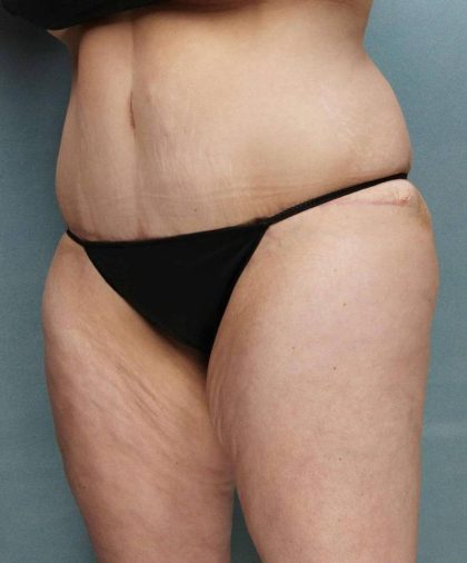 Weight Loss Before & After Patient #9172